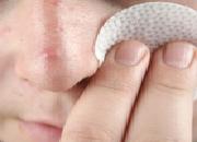 にきび 原因 治療